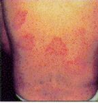 erythema migrans rash ("migrating redness"), as seen in North American Lyme borreliosis